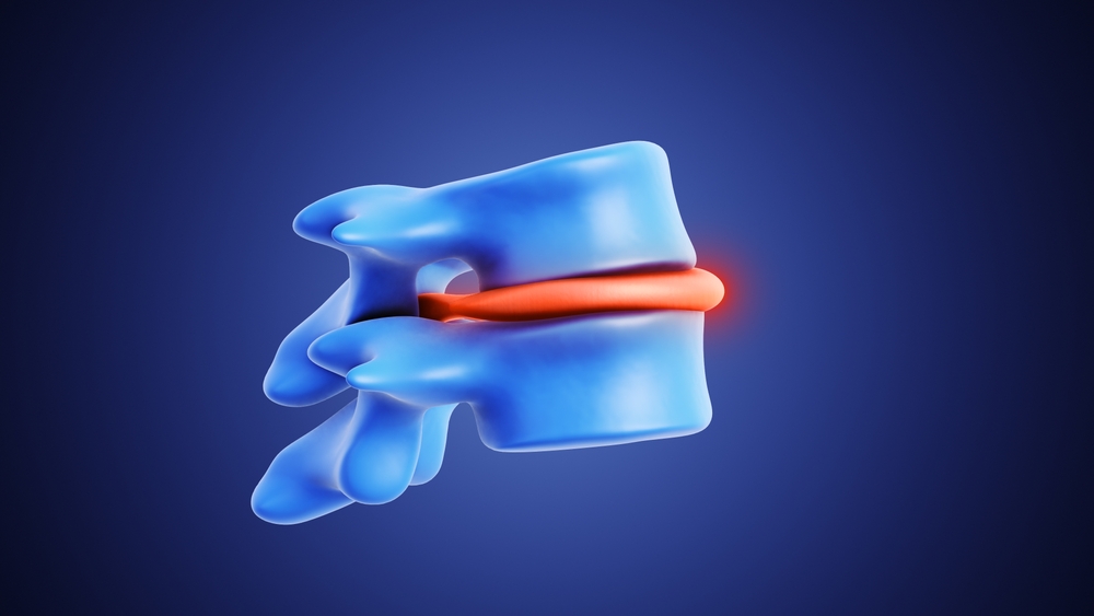 Herniated Disc vs Bulging Disc