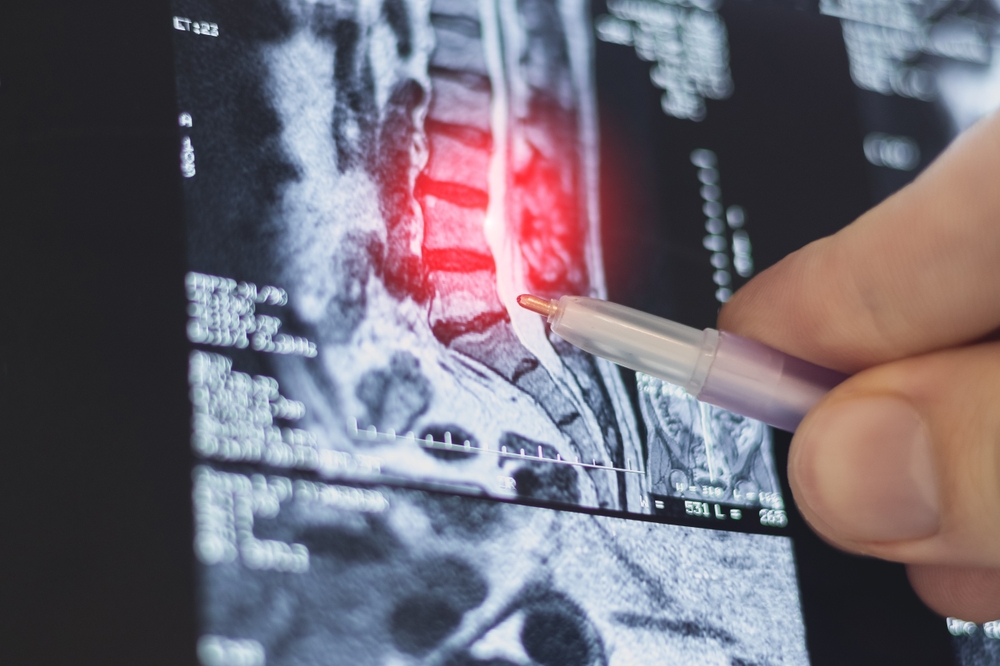 Spinal Decompression vs Surgery for Herniated Discs